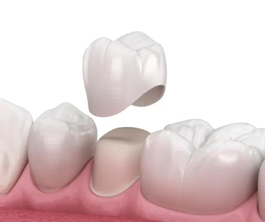 Dental Crowns Graphic